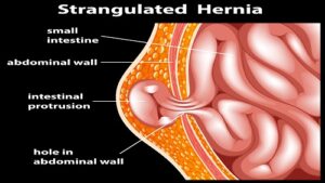 Treatment hiatal hernia